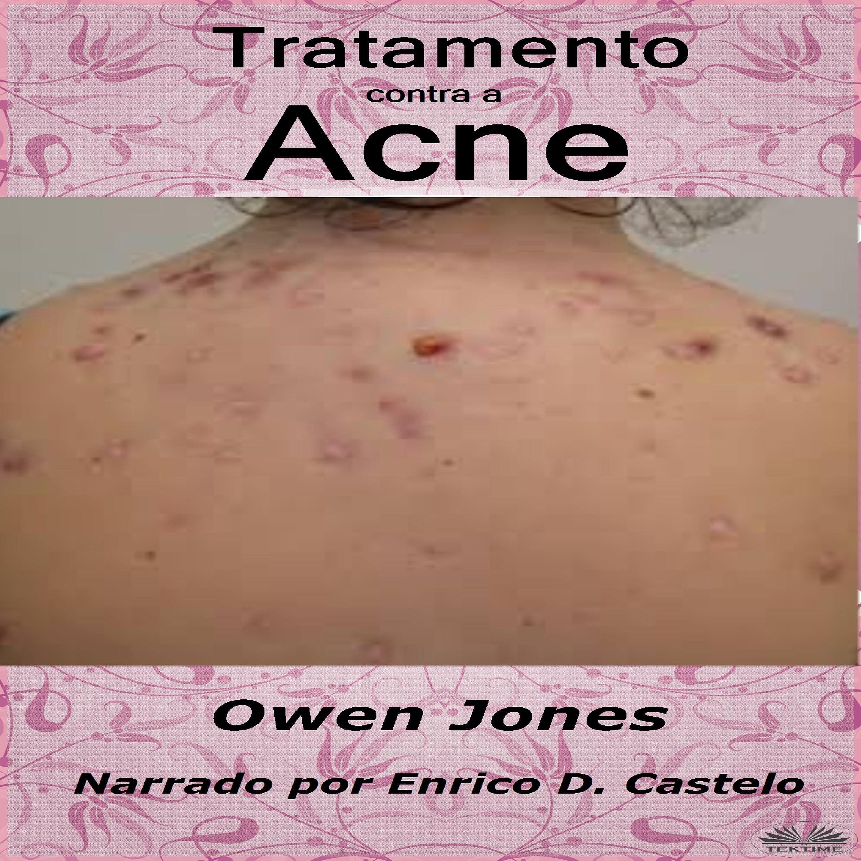 Tratamento contra a acne