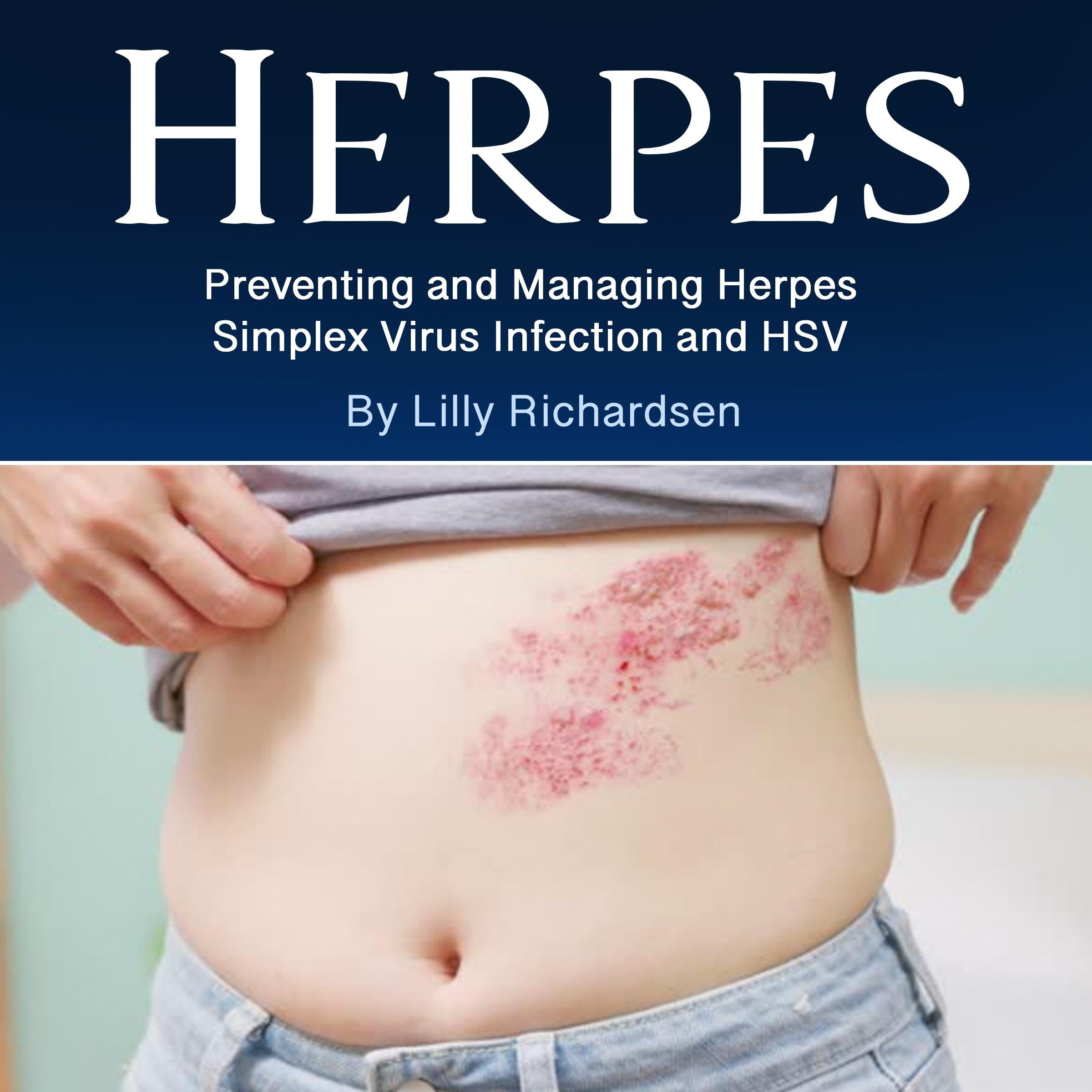 Herpes