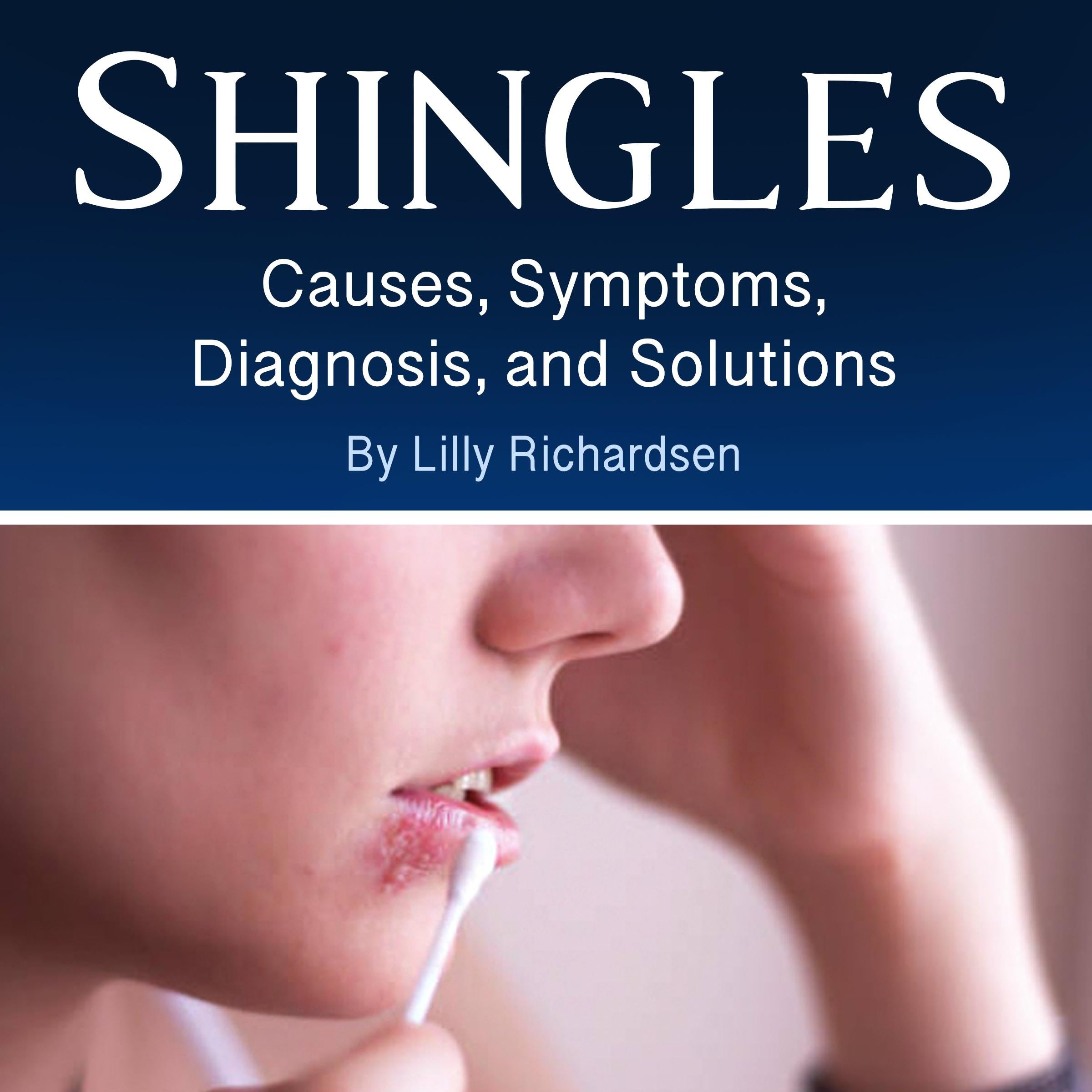 Shingles
