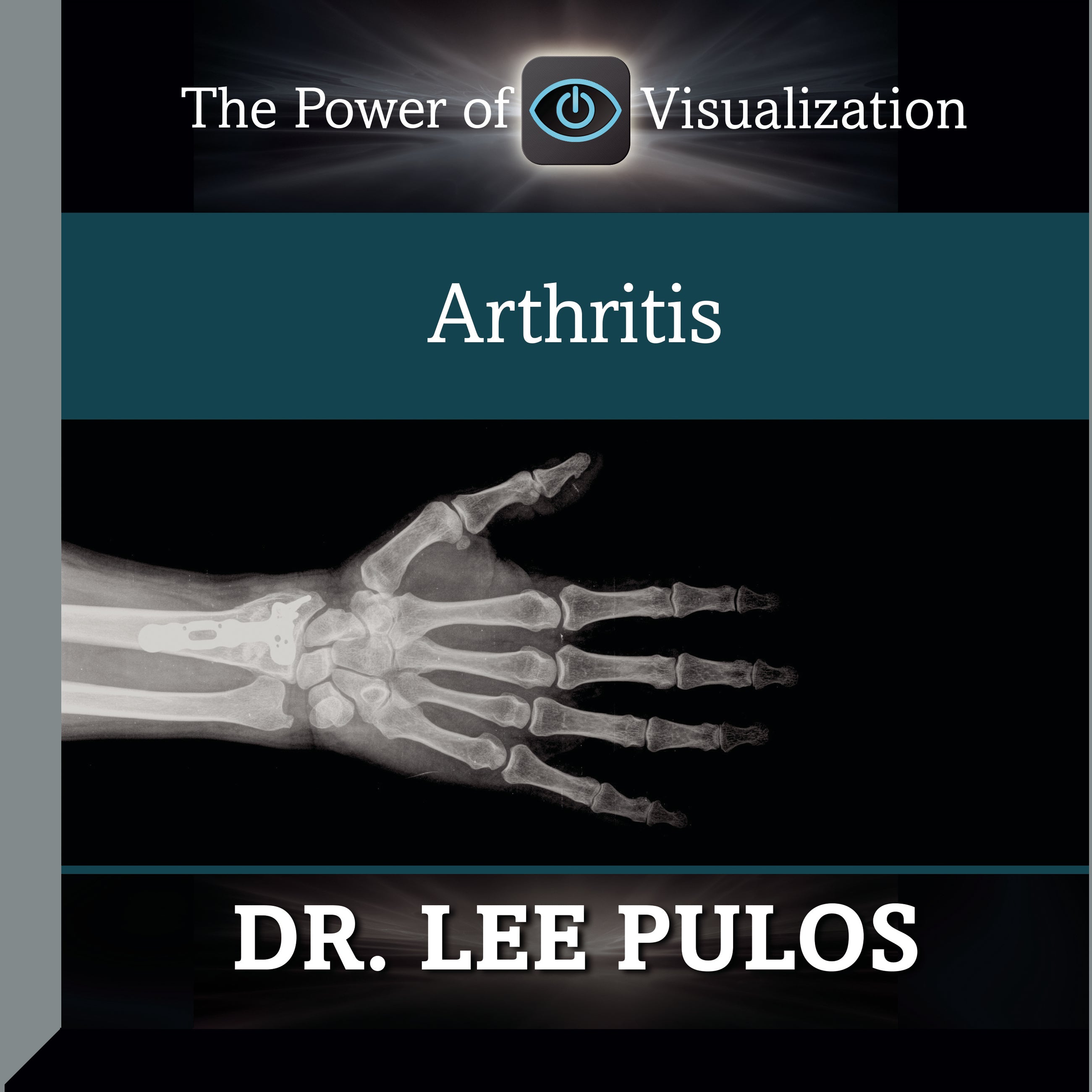 Arthritis