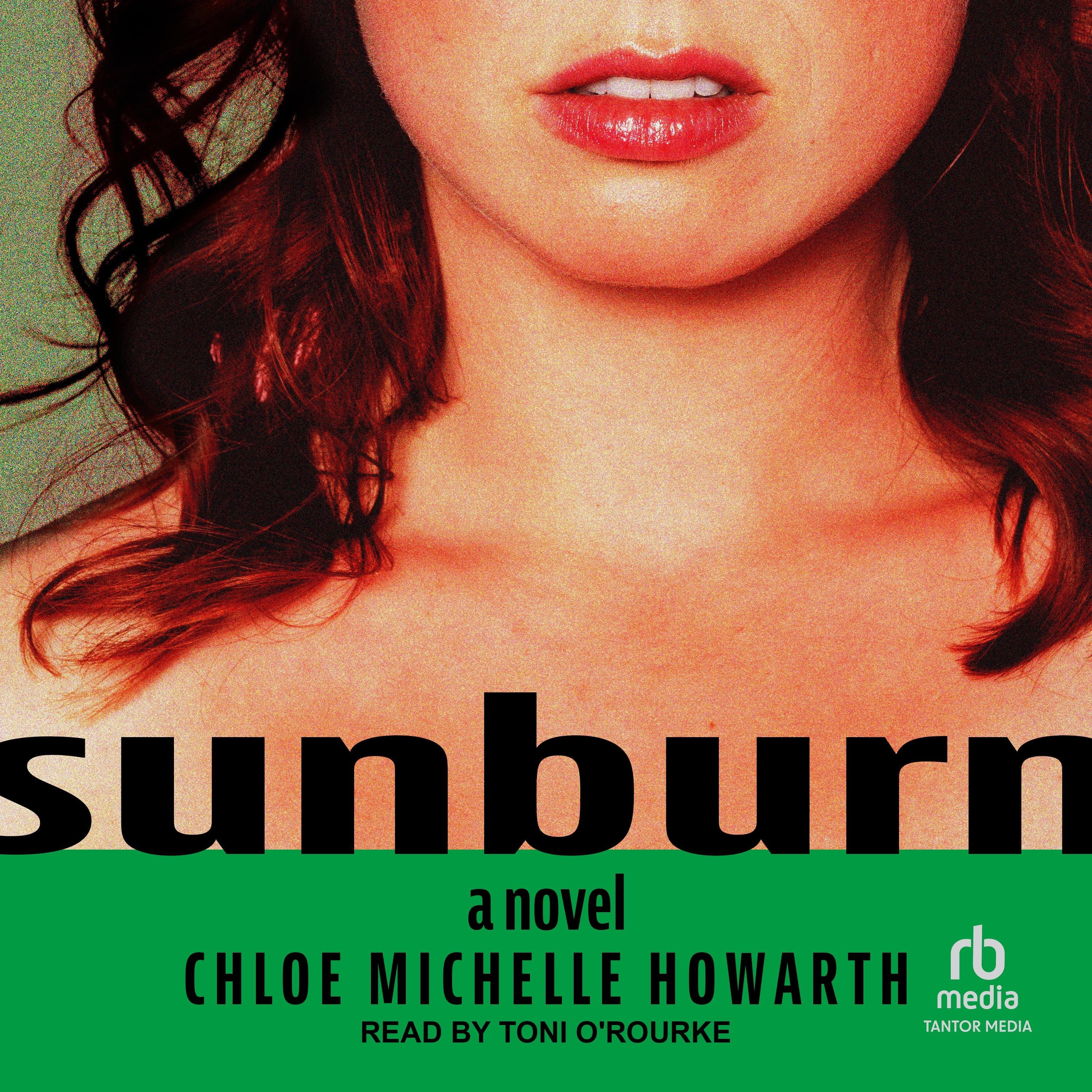 Sunburn