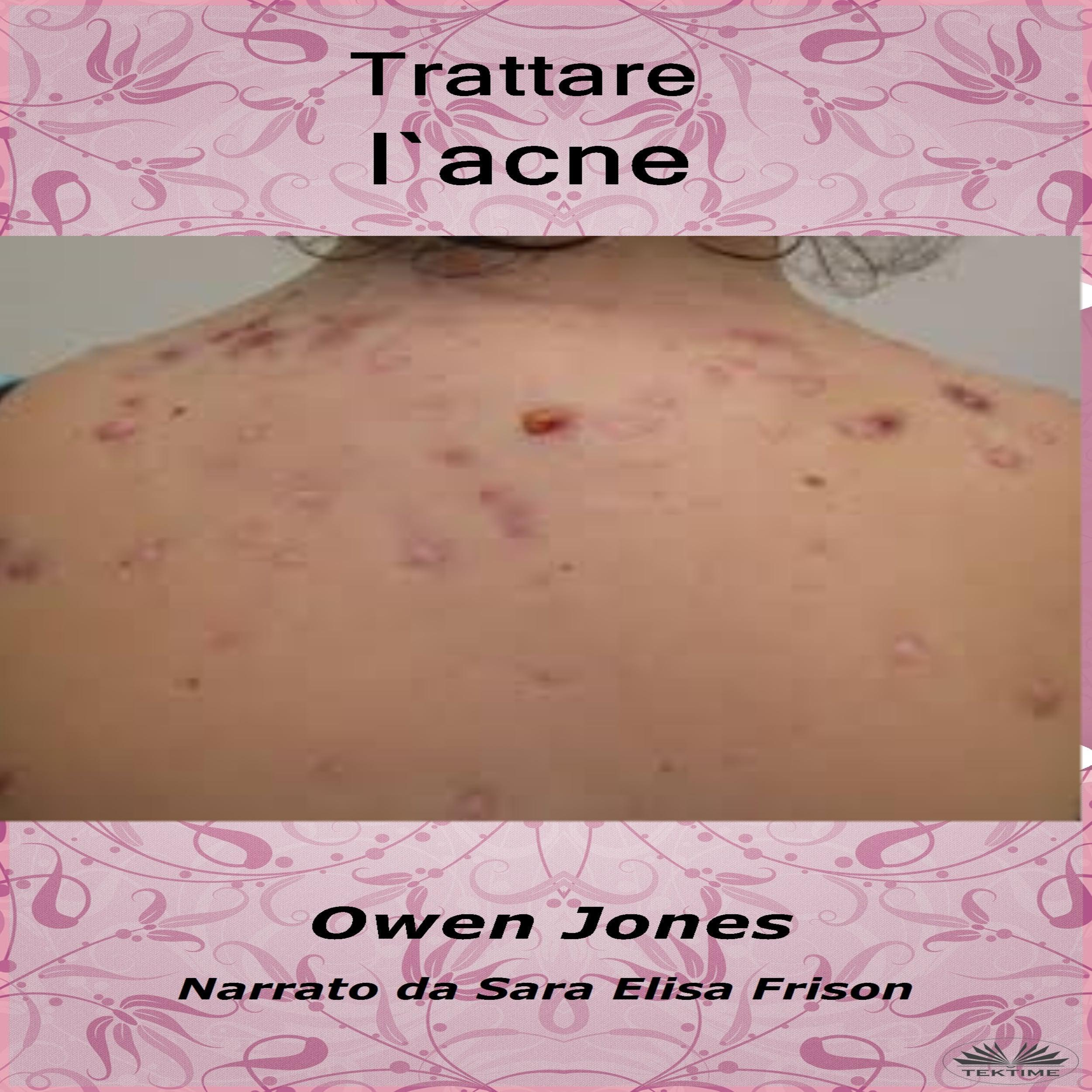 Trattare l`acne
