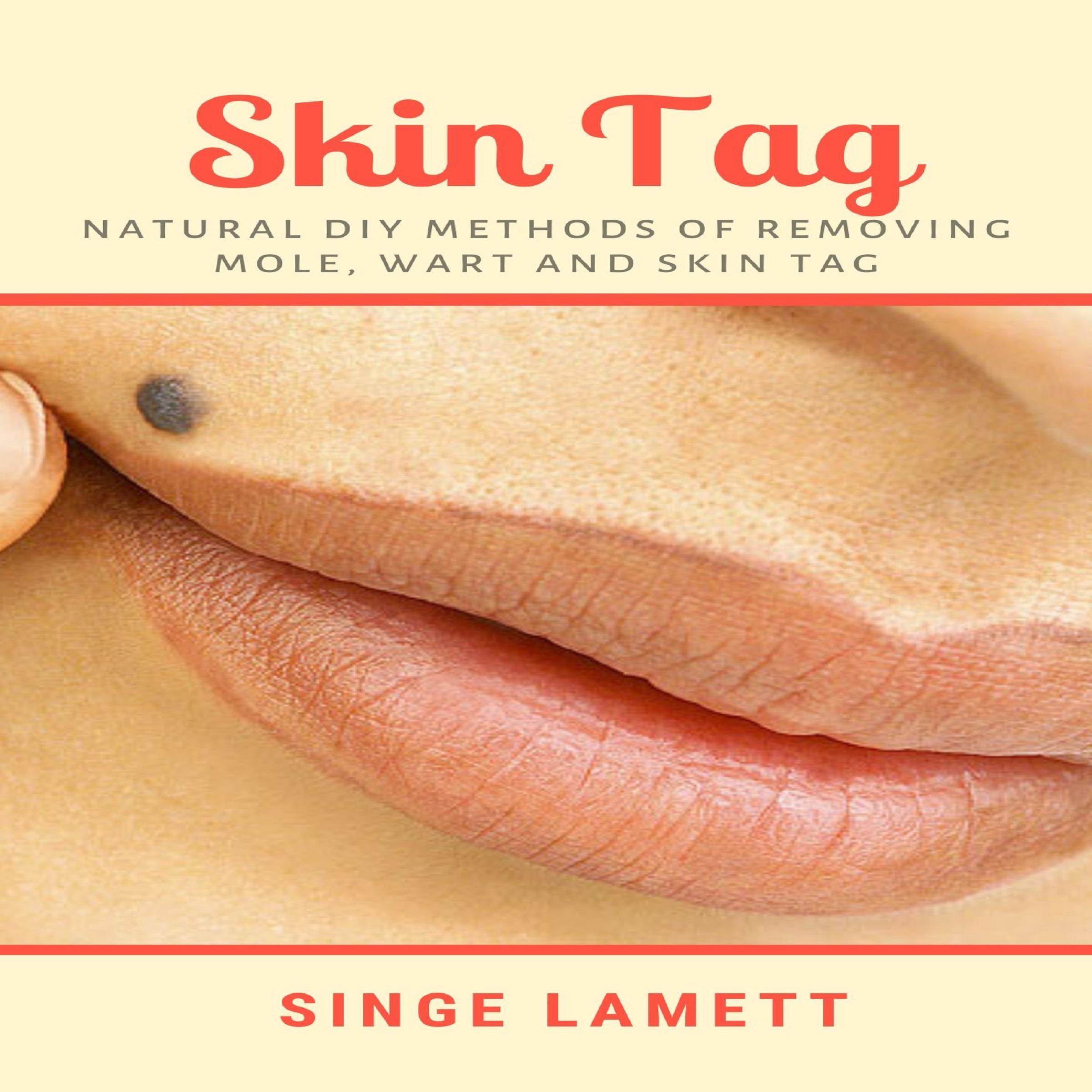 Skin Tag