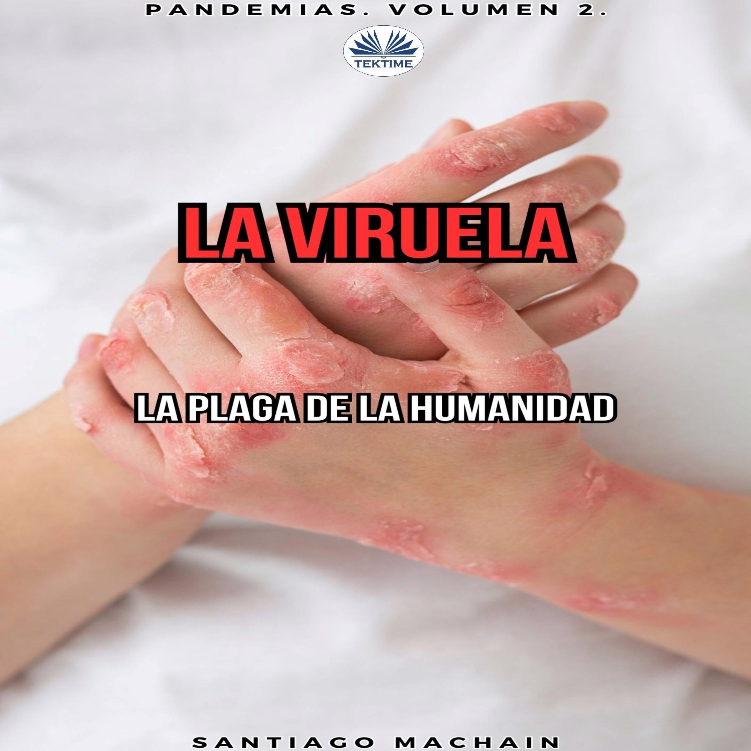 La Viruela